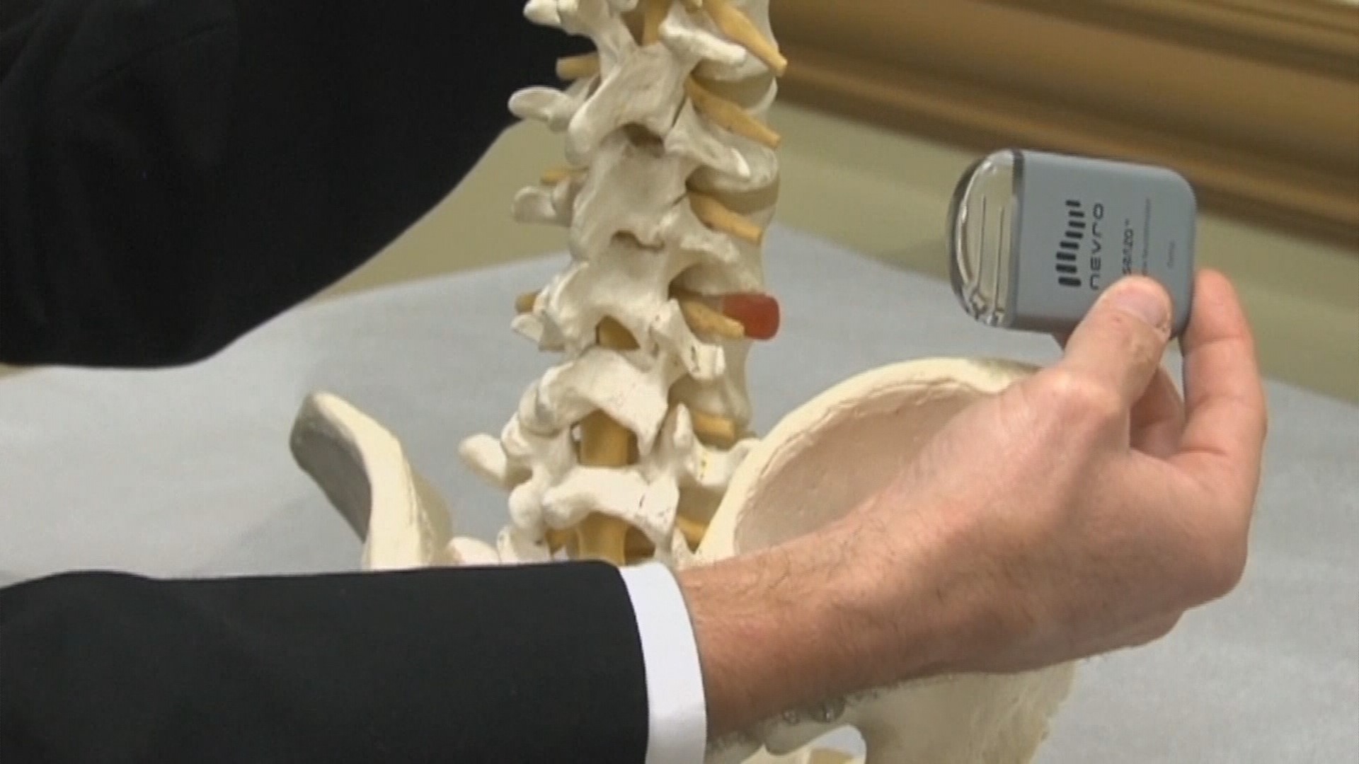 New nerve stimulator improves back pain management